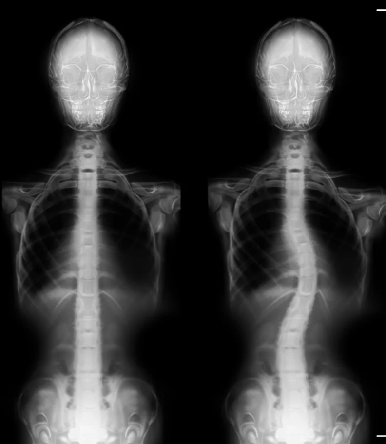 Scoliosis Rancho Cucamonga